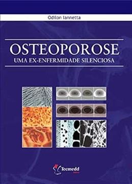 Imagem de OSTEOPOROSE