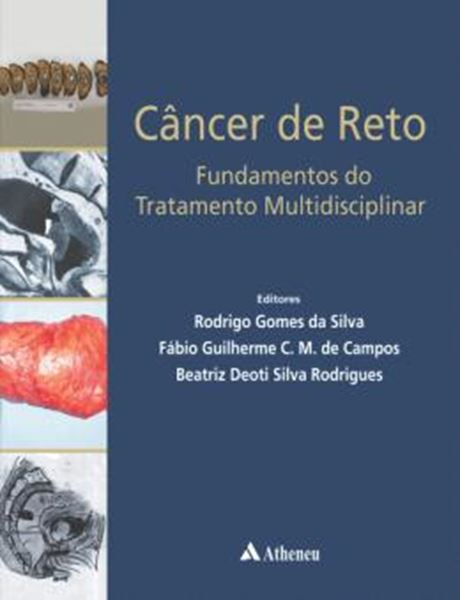 Picture of CANCER DO RETO - FUNDAMENTOS DO TRATAMENTO MULTIDISCIPLINAR