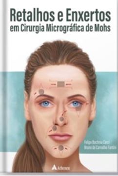 Imagem de RETALHOS E ENXERTOS EM CIRURGIA MICROGRAFICA DE MOHS