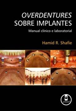 Imagem de OVERDENTURES SOBRE IMPLANTES - MANUAL CLINICO E LABORATORIAL